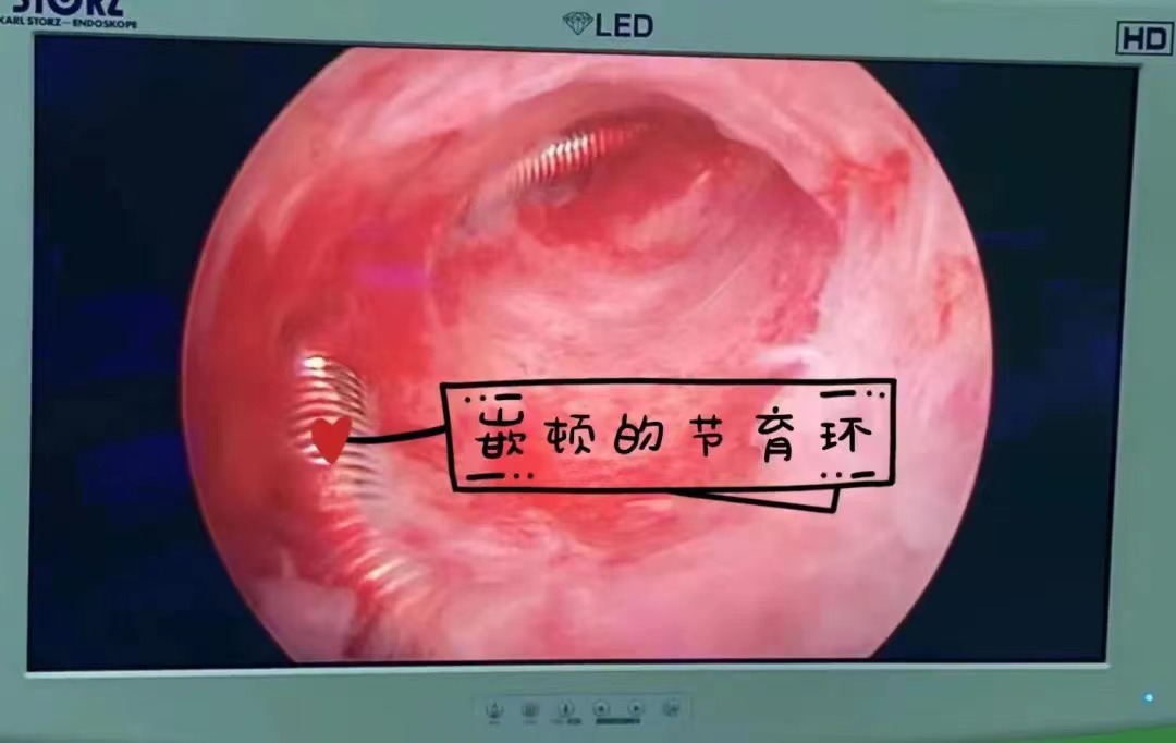 我院妇科曾经收治的患者中,就有金属节育器的尖端刺入子宫肌层导致大